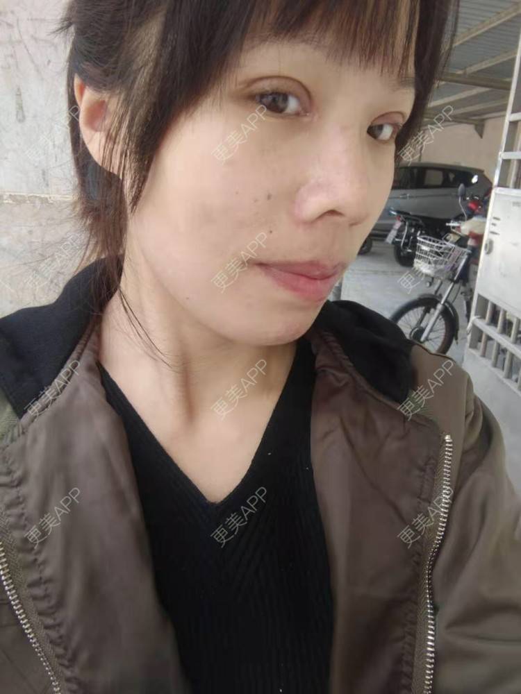 更美 - 我叫小芳的凸嘴矫正经验 | 凸嘴矫正 | 广州