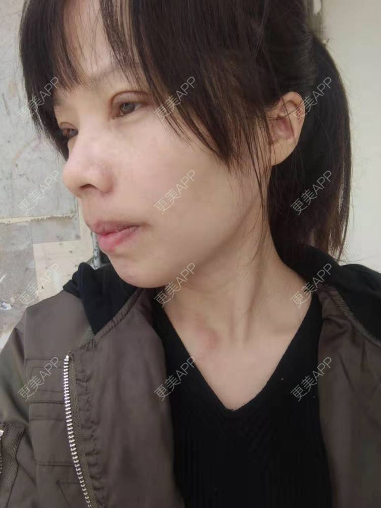 更美 - 我叫小芳的凸嘴矫正经验 | 凸嘴矫正 | 广州