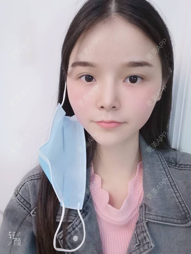 更美 - 莫宁🌸的自体脂肪填充泪沟经验 | 自体脂肪丰太阳穴 | 自体脂肪丰额头 | 自体脂肪丰苹果肌 | 自体脂肪丰面颊 | 自体脂肪填充泪沟 | 自体脂肪垫下巴 | 广州 | 视频日记