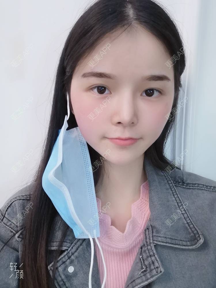 更美 - 莫宁🌸的自体脂肪填充泪沟经验 | 自体脂肪丰太阳穴 | 自体脂肪丰额头 | 自体脂肪丰苹果肌 | 自体脂肪丰面颊 | 自体脂肪填充泪沟 | 自体脂肪垫下巴 | 广州 | 视频日记