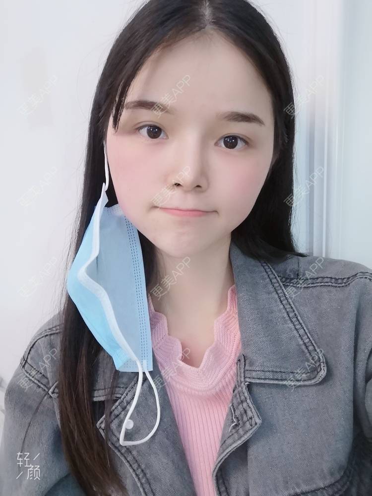 更美 - 莫宁🌸的自体脂肪填充泪沟经验 | 自体脂肪丰太阳穴 | 自体脂肪丰额头 | 自体脂肪丰苹果肌 | 自体脂肪丰面颊 | 自体脂肪填充泪沟 | 自体脂肪垫下巴 | 广州 | 视频日记