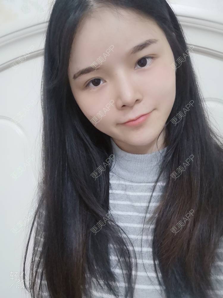 更美 - 莫宁🌸的自体脂肪填充泪沟经验 | 自体脂肪丰太阳穴 | 自体脂肪丰额头 | 自体脂肪丰苹果肌 | 自体脂肪丰面颊 | 自体脂肪填充泪沟 | 自体脂肪垫下巴 | 广州 | 视频日记