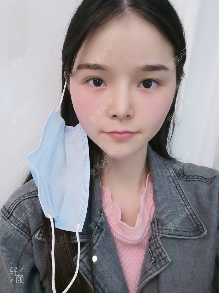 更美 - 莫宁🌸的自体脂肪填充泪沟经验 | 自体脂肪丰太阳穴 | 自体脂肪丰额头 | 自体脂肪丰苹果肌 | 自体脂肪丰面颊 | 自体脂肪填充泪沟 | 自体脂肪垫下巴 | 广州 | 视频日记