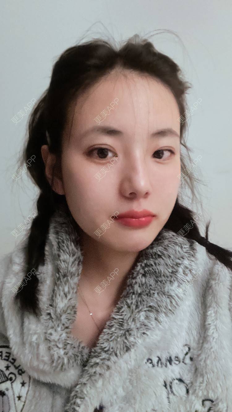 更美 - 菲儿好菇凉的双眼皮经验 | 双眼皮 | 全切双眼皮 | 埋线双眼皮 | 定点双眼皮 | 眼皮下垂矫正 | 重庆 | 上眼睑去脂 | 眼部多项