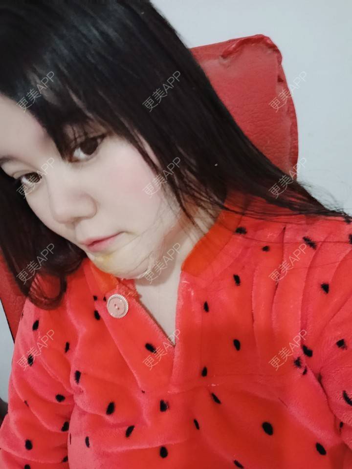 更美 - sonder.的下巴经验 | 硅胶垫下巴 | 下巴 | 长沙 | 视频日记