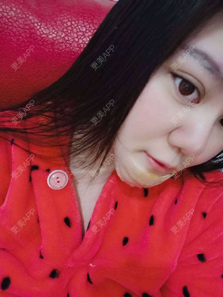 更美 - sonder.的下巴经验 | 硅胶垫下巴 | 下巴 | 长沙 | 视频日记