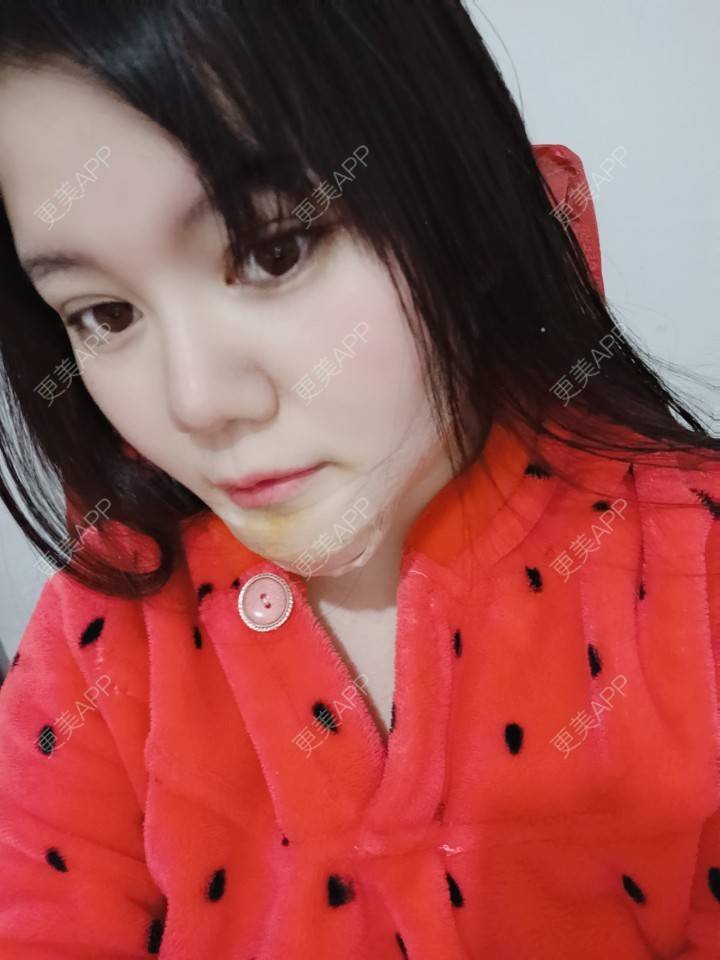 更美 - sonder.的下巴经验 | 硅胶垫下巴 | 下巴 | 长沙 | 视频日记