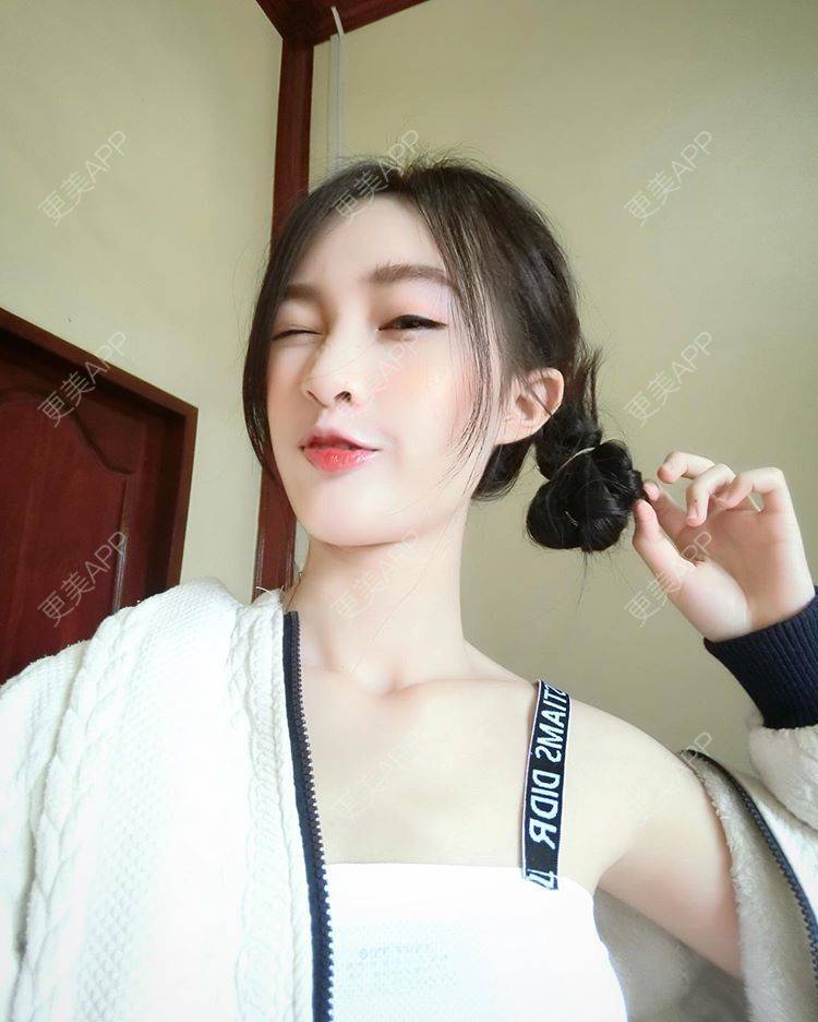更美 - 云如枫的玻尿酸导入经验 | 玻尿酸导入 | 深圳