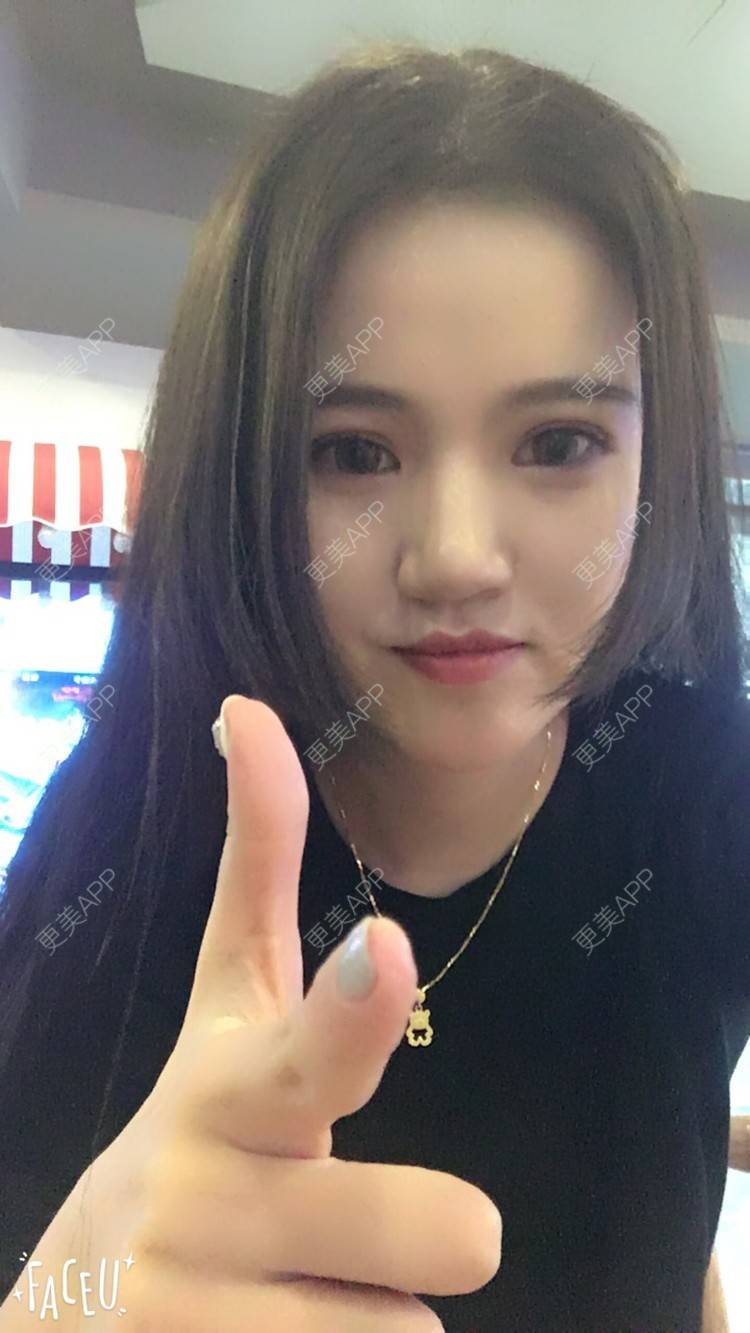 更美 - 更美用户T8WaNbmjvG的热玛吉经验 | 深圳 | 热玛吉 | 超声提升 | 埋线提升 | 热拉提