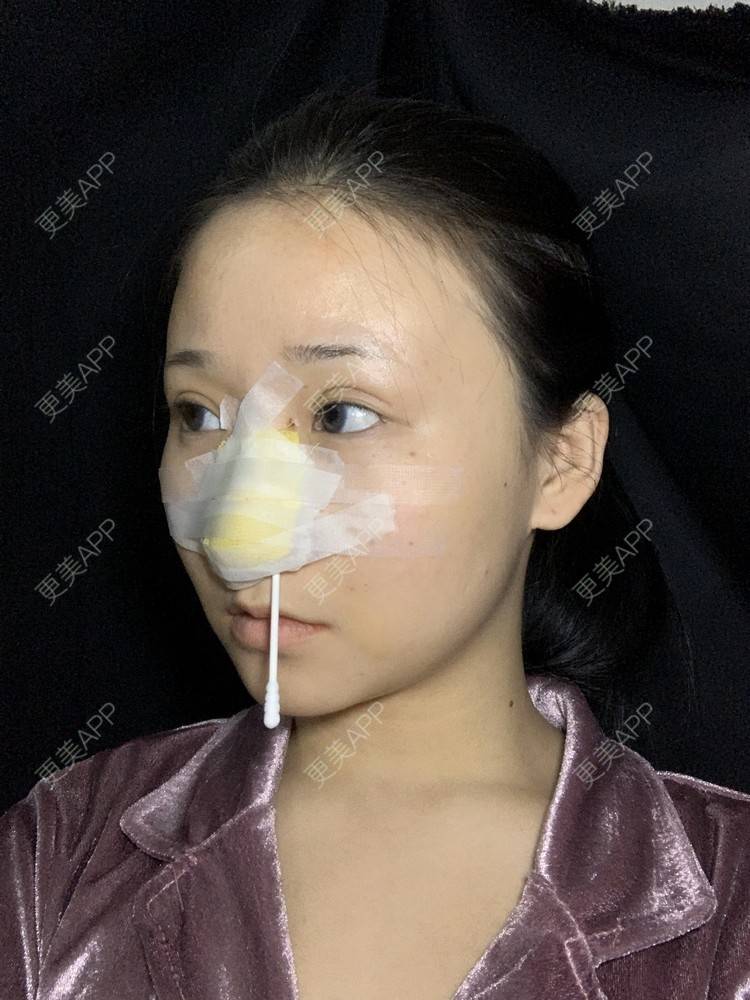 更美 - 更美用户A9XbUpVyAA的鼻部多项经验 | 鼻部多项 | 鼻翼缩小 | 假体垫鼻基底 | 人工骨隆鼻 | 长鼻矫正 | 福州
