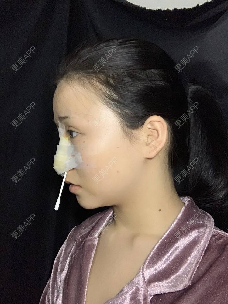更美 - 更美用户A9XbUpVyAA的鼻部多项经验 | 鼻部多项 | 鼻翼缩小 | 假体垫鼻基底 | 人工骨隆鼻 | 长鼻矫正 | 福州