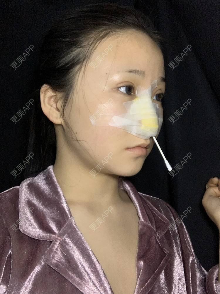 更美 - 更美用户A9XbUpVyAA的鼻部多项经验 | 鼻部多项 | 鼻翼缩小 | 假体垫鼻基底 | 人工骨隆鼻 | 长鼻矫正 | 福州