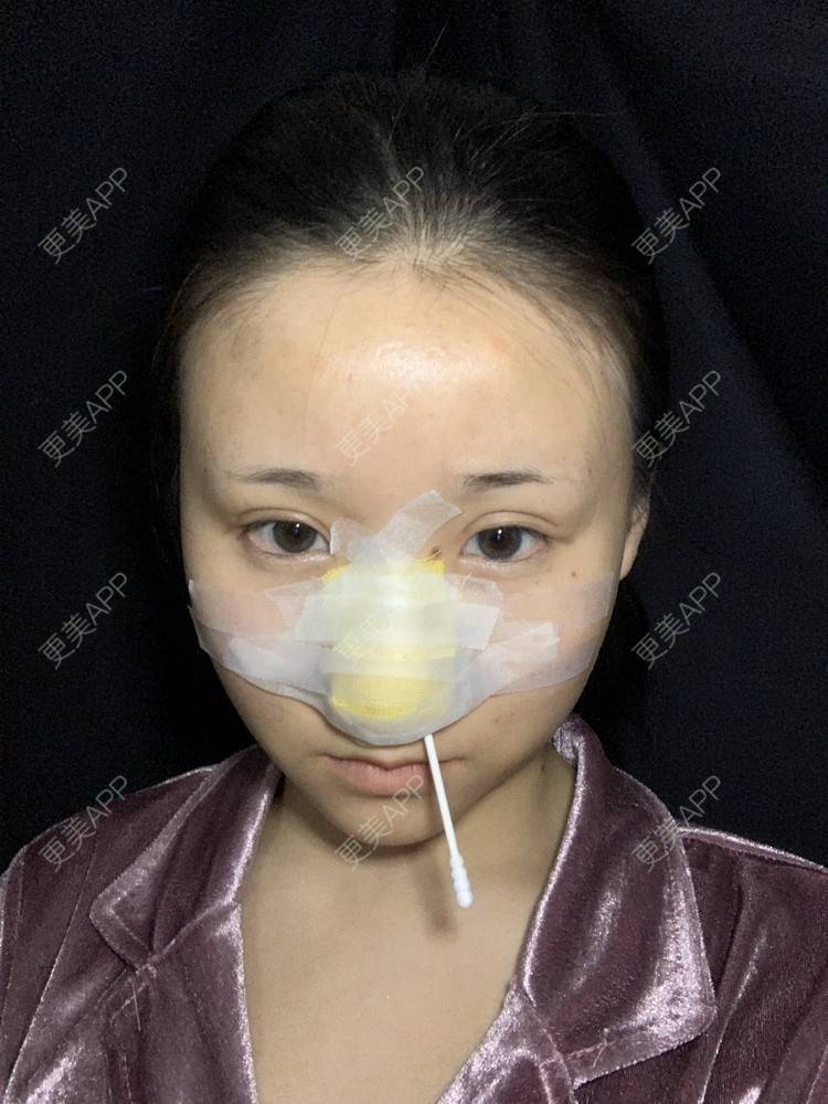 更美 - 更美用户A9XbUpVyAA的鼻部多项经验 | 鼻部多项 | 鼻翼缩小 | 假体垫鼻基底 | 人工骨隆鼻 | 长鼻矫正 | 福州