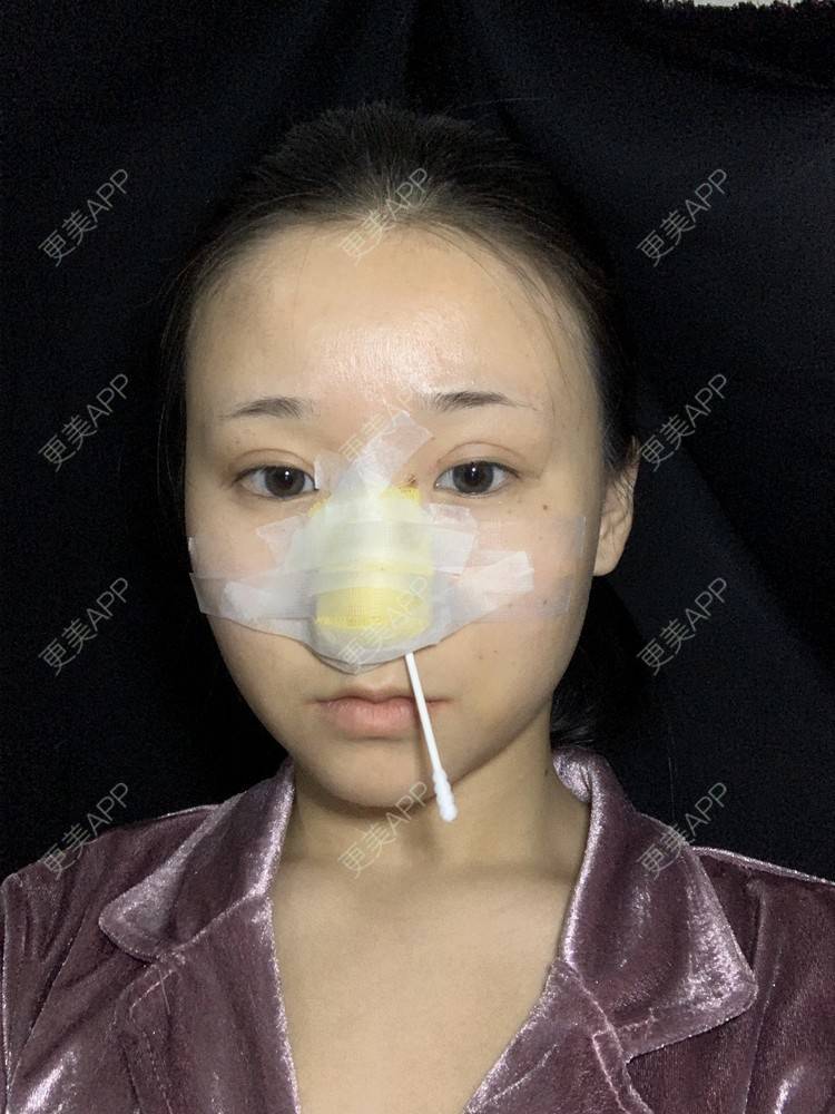 更美 - 更美用户A9XbUpVyAA的鼻部多项经验 | 鼻部多项 | 鼻翼缩小 | 假体垫鼻基底 | 人工骨隆鼻 | 长鼻矫正 | 福州