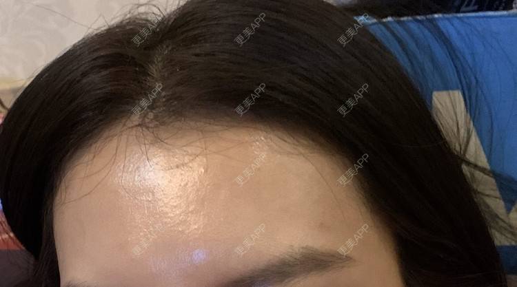 更美 - 更美用户CUVg97dlGa的微针水光经验 | 重庆 | 微针水光