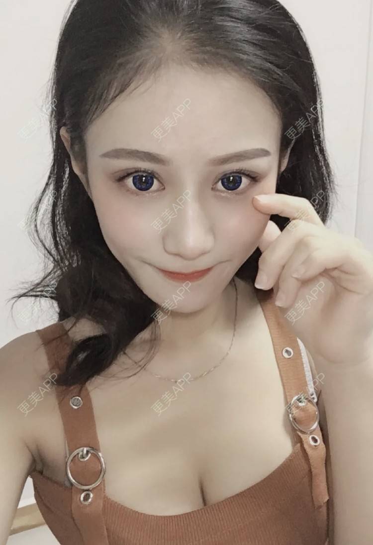 更美 - 更美用户2ldFVUKSO7的假体隆胸经验 | 假体隆胸 | 南昌
