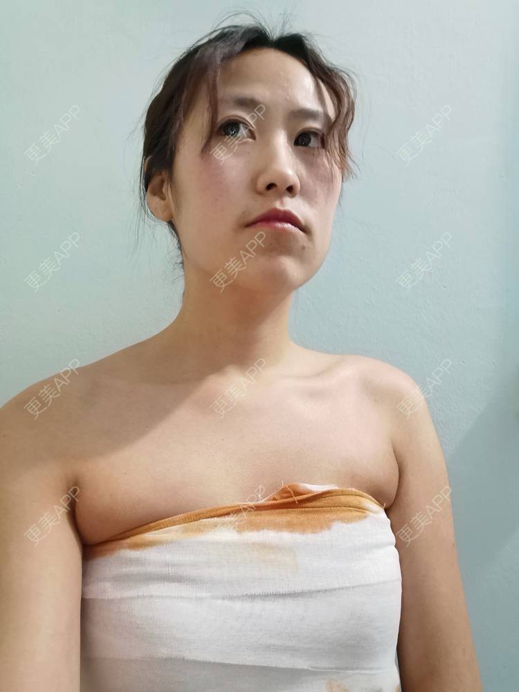 更美用户ddcvxeioxo的假体隆胸日记