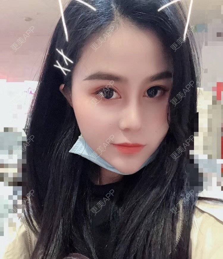 更美 - 更美用户zwQN5e8jIh的鼻部多项经验 | 鼻部多项 | 长沙