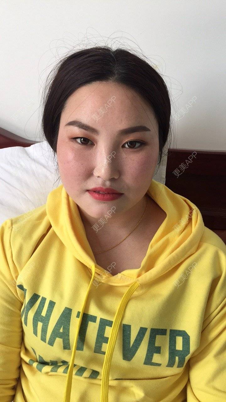 更美 - 水依人的皮秒激光经验 | 上海 | 皮秒激光