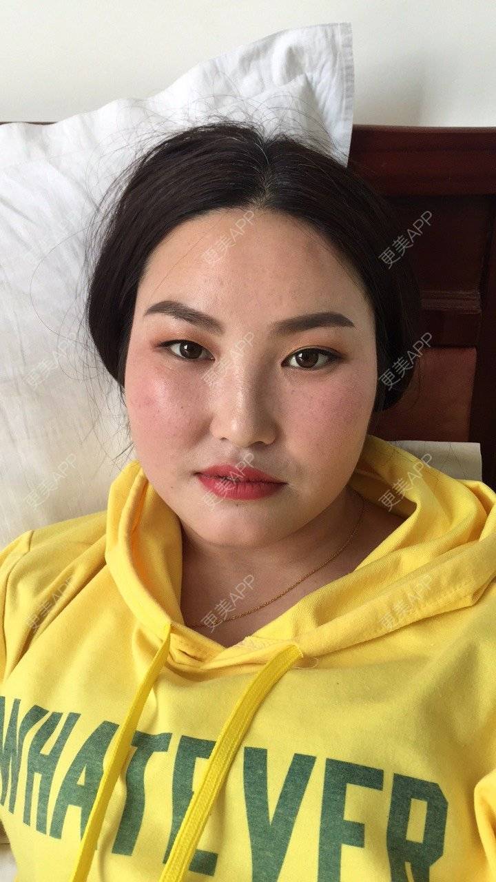 更美 - 水依人的皮秒激光经验 | 上海 | 皮秒激光