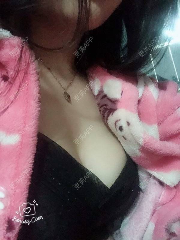 更美 - 想走就走啊的自体脂肪隆胸经验 | 上海 | 自体脂肪隆胸