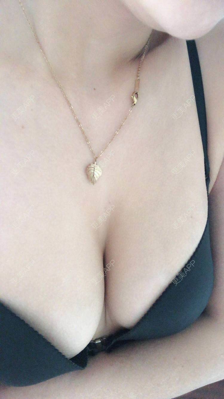 更美 - 想走就走啊的自体脂肪隆胸经验 | 上海 | 自体脂肪隆胸