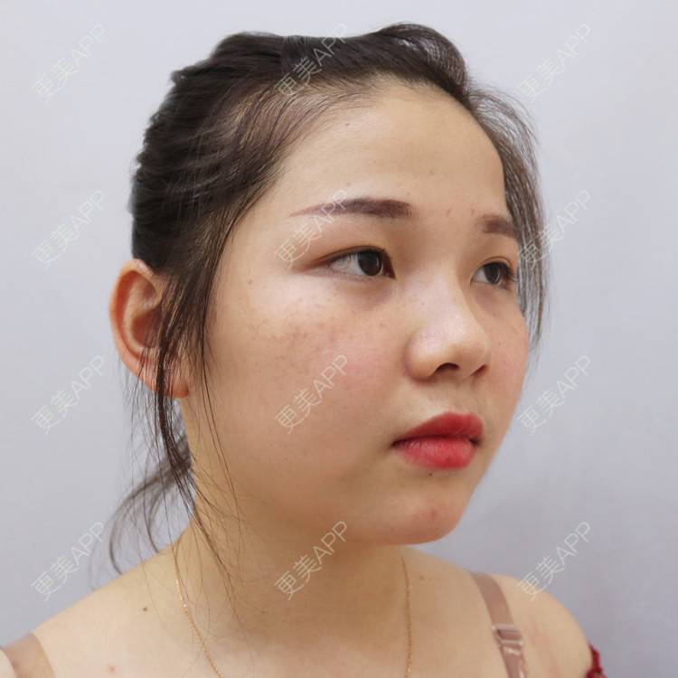 更美 - 更美用户CmMAvEROQj的激光淡疤经验 | 激光淡疤 | 南宁