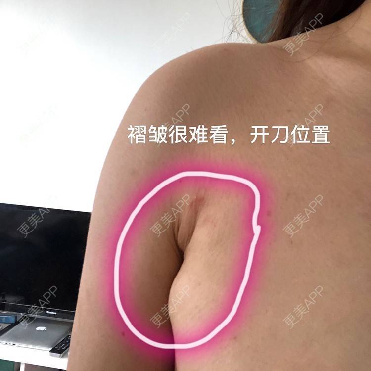更美 - 幼熙baby的吸脂去副乳经验 | 吸脂去副乳 | 深圳