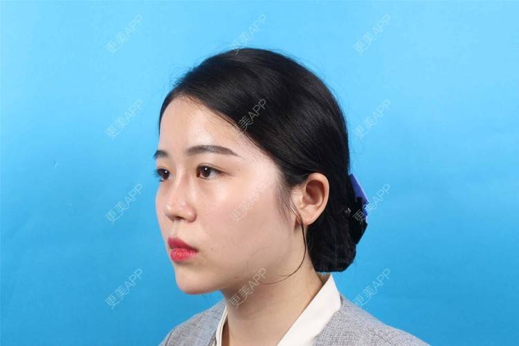 更美 - 更美用户cA33i6DxJX的玻尿酸下巴经验 | 玻尿酸下巴 | 上饶