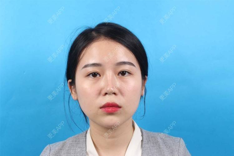 更美 - 更美用户cA33i6DxJX的玻尿酸下巴经验 | 玻尿酸下巴 | 上饶