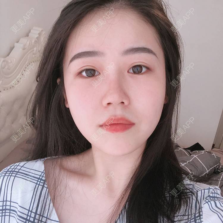 更美 - 更美用户cA33i6DxJX的玻尿酸下巴经验 | 玻尿酸下巴 | 上饶