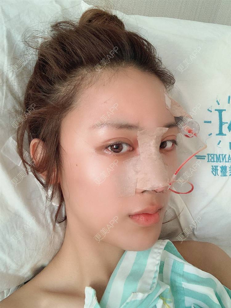 更美 - 更美用户1HlUvPqBUh的鼻部多项经验 | 青岛 | 鼻部多项
