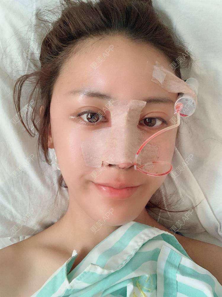 更美 - 更美用户1HlUvPqBUh的鼻部多项经验 | 青岛 | 鼻部多项