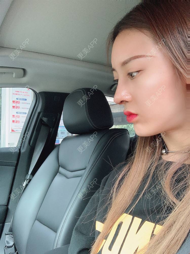 更美 - 更美用户1HlUvPqBUh的鼻部多项经验 | 青岛 | 鼻部多项