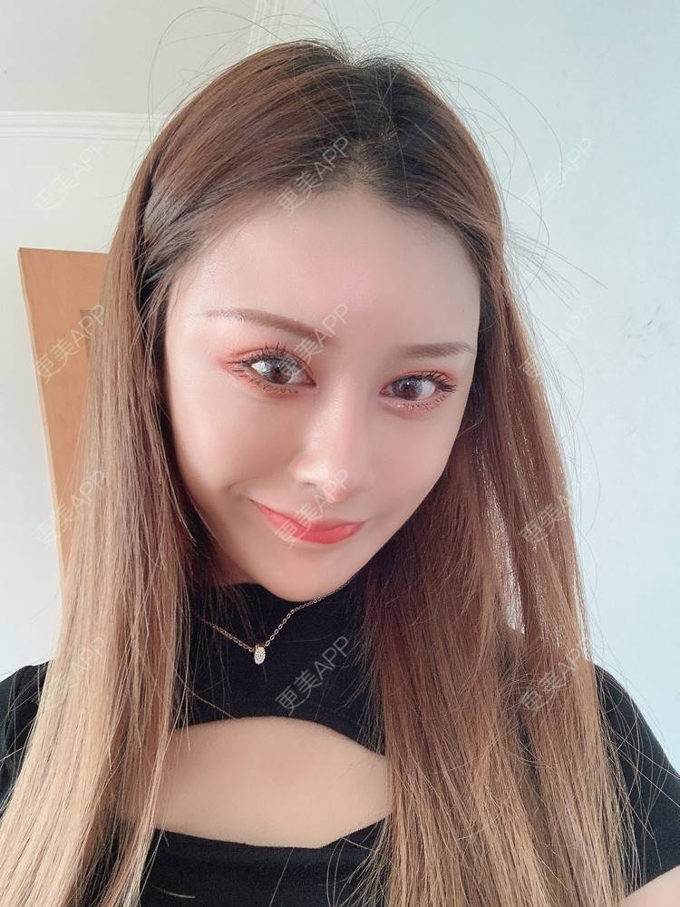 更美 - 更美用户1HlUvPqBUh的鼻部多项经验 | 青岛 | 鼻部多项