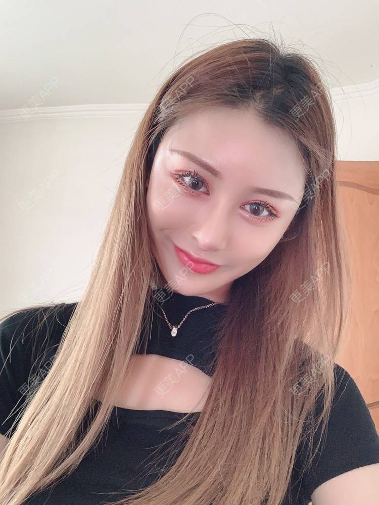更美 - 更美用户1HlUvPqBUh的鼻部多项经验 | 青岛 | 鼻部多项