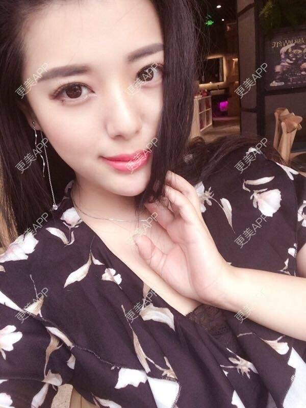 更美 - 嘿嘿 你猜猜我是谁的玻尿酸下巴经验 | 硅胶垫下巴 | 膨体垫下巴 | 宽下巴矫正 | 玻尿酸下巴 | 缩下巴 | 成都
