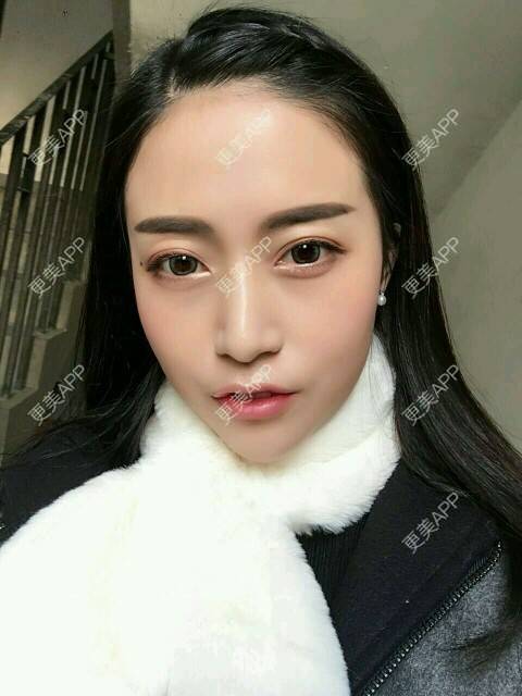 更美 - 心中始终有你的玻尿酸下巴经验 | 玻尿酸下巴 | 硅胶垫下巴 | 膨体垫下巴 | 缩下巴 | 成都