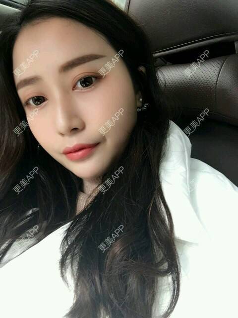 更美 - 心中始终有你的玻尿酸下巴经验 | 玻尿酸下巴 | 硅胶垫下巴 | 膨体垫下巴 | 缩下巴 | 成都