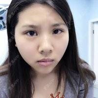 更美 - 更美用户XbadwS1VZm的全切双眼皮经验 | 全切双眼皮 | 埋线双眼皮 | 定点双眼皮 | 成都 | 眼睑下至 | 双眼皮修复