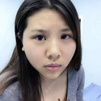 更美 - 更美用户XbadwS1VZm的全切双眼皮经验 | 全切双眼皮 | 埋线双眼皮 | 定点双眼皮 | 成都 | 眼睑下至 | 双眼皮修复