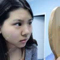 更美 - 更美用户XbadwS1VZm的全切双眼皮经验 | 全切双眼皮 | 埋线双眼皮 | 定点双眼皮 | 成都 | 眼睑下至 | 双眼皮修复