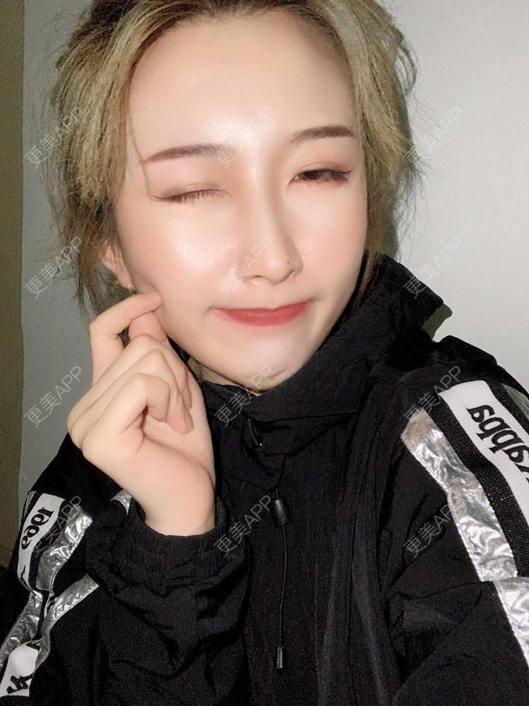 更美 - 更美用户KtaWOoiEh5的埋线提升经验 | 埋线提升 | 东莞