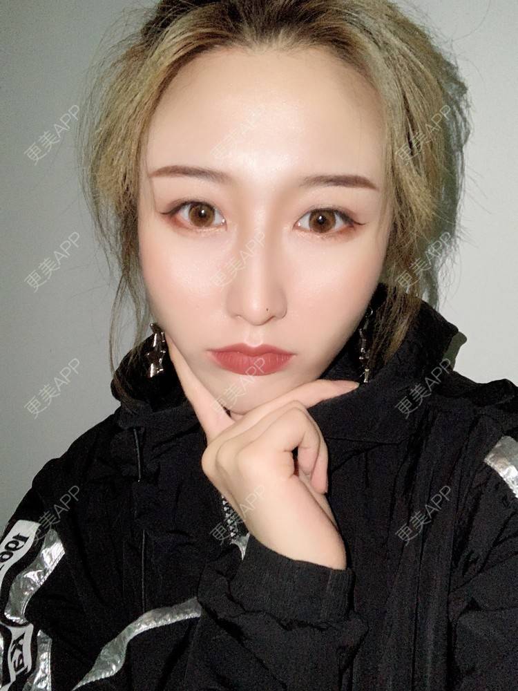 更美 - 更美用户KtaWOoiEh5的埋线提升经验 | 埋线提升 | 东莞
