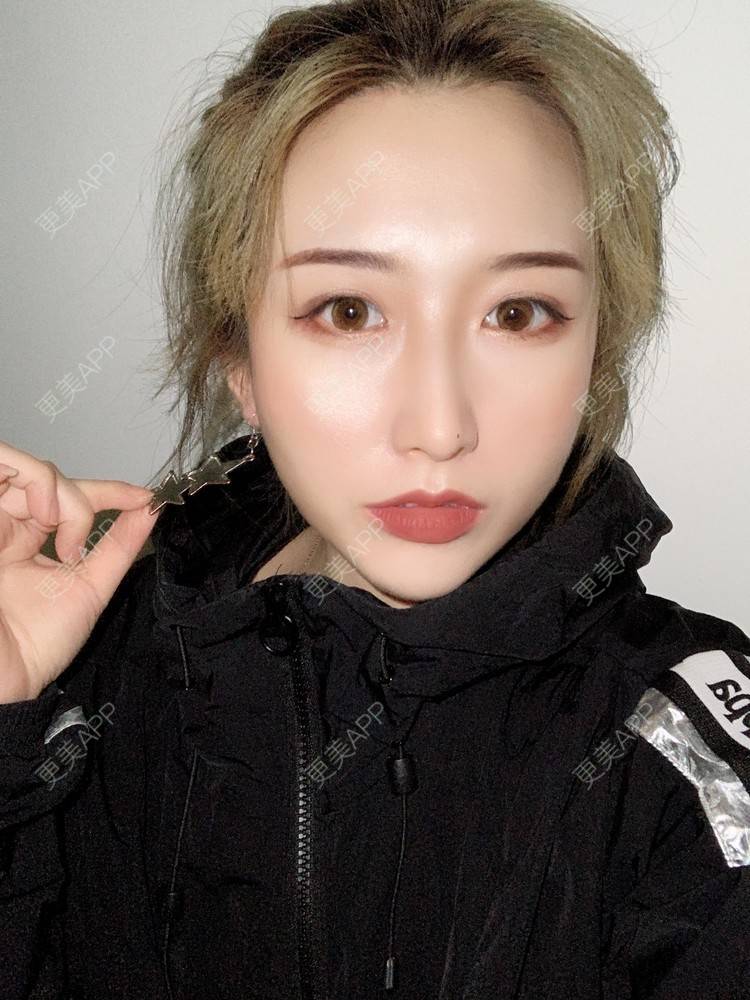 更美 - 更美用户KtaWOoiEh5的埋线提升经验 | 埋线提升 | 东莞