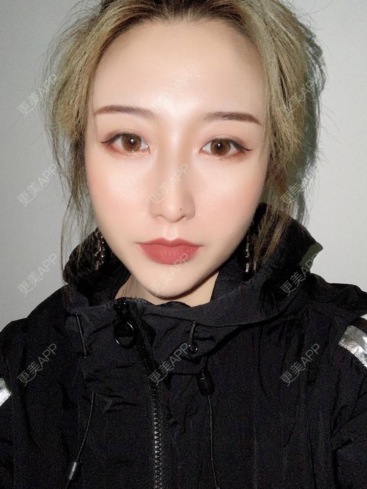 更美 - 更美用户KtaWOoiEh5的埋线提升经验 | 埋线提升 | 东莞