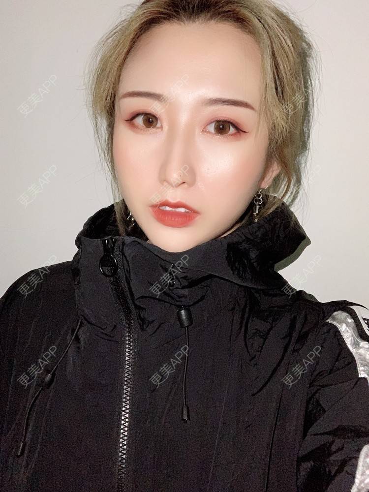 更美 - 更美用户KtaWOoiEh5的埋线提升经验 | 埋线提升 | 东莞