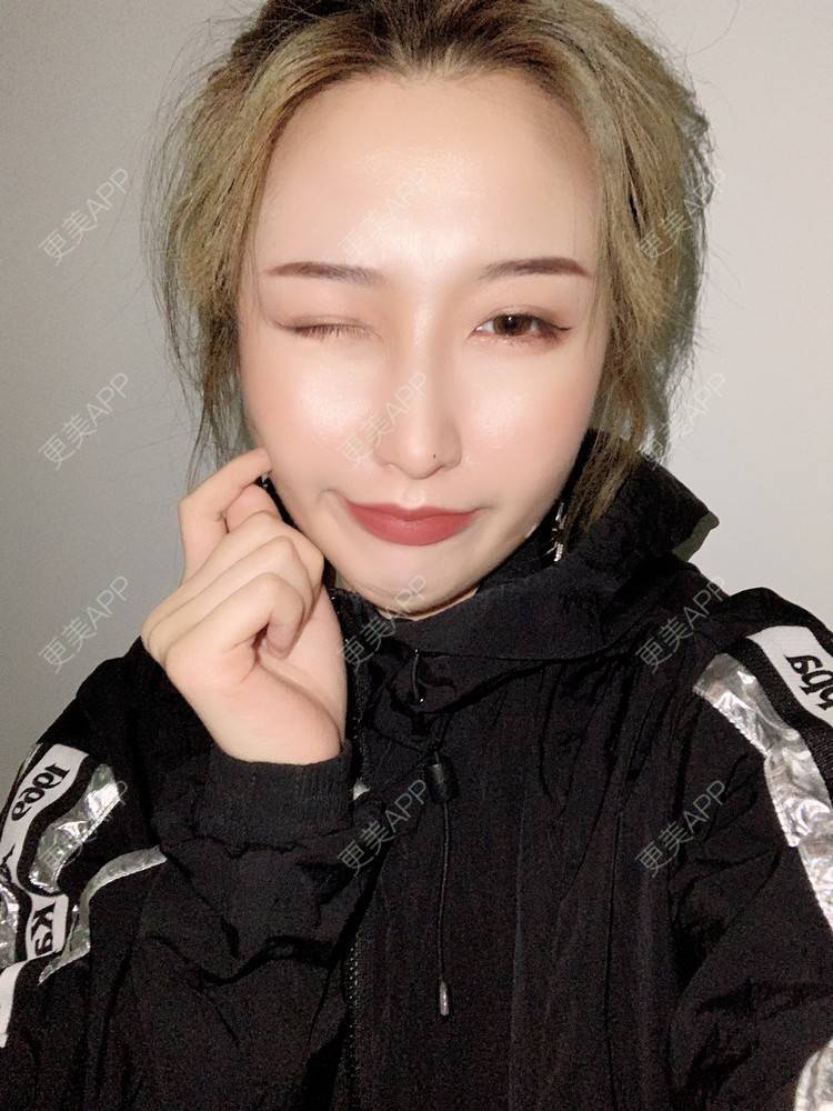 更美 - 更美用户KtaWOoiEh5的埋线提升经验 | 埋线提升 | 东莞