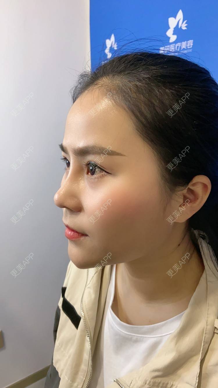 更美 - 更美用户zwQN5e8jIh的鼻部多项经验 | 鼻部多项 | 长沙