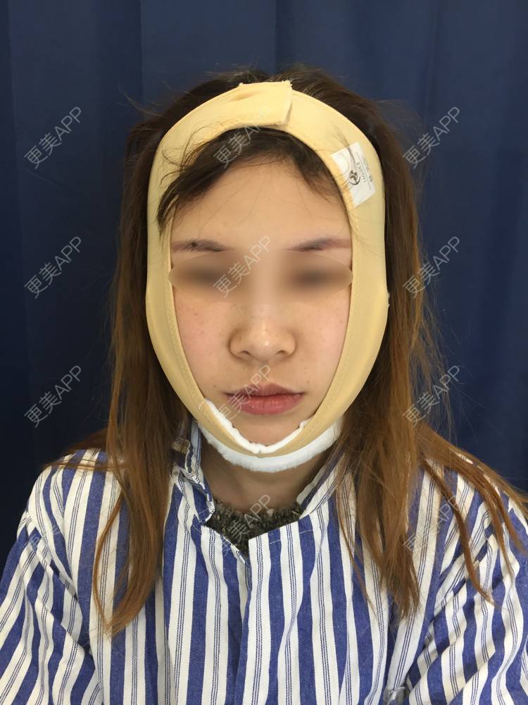 更美 - 蓝涵涵的拉皮经验 | 拉皮 | 广州